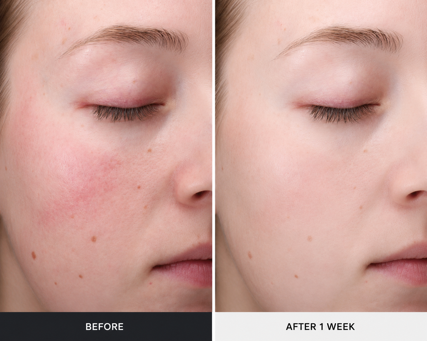 Before and after results showing improved skin texture, reduced redness, and a smoother complexion after one week of using Revision Skincare Radiance+ Resurfacing Serum